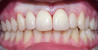 Tooting Bec Dental invisalign