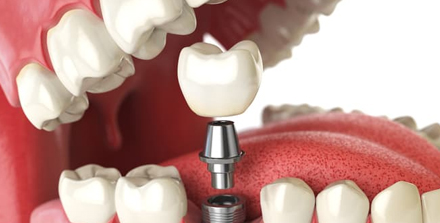 tooting bec dental implants