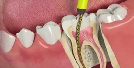 tooting bec root canal