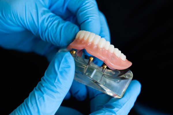 Implant Dentures